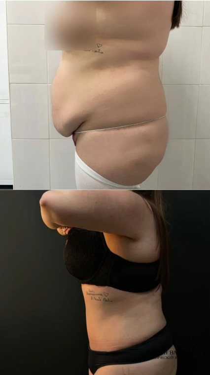 Дочь Иосифа Пригожина опубликовала фото в белье после абдоминопластики